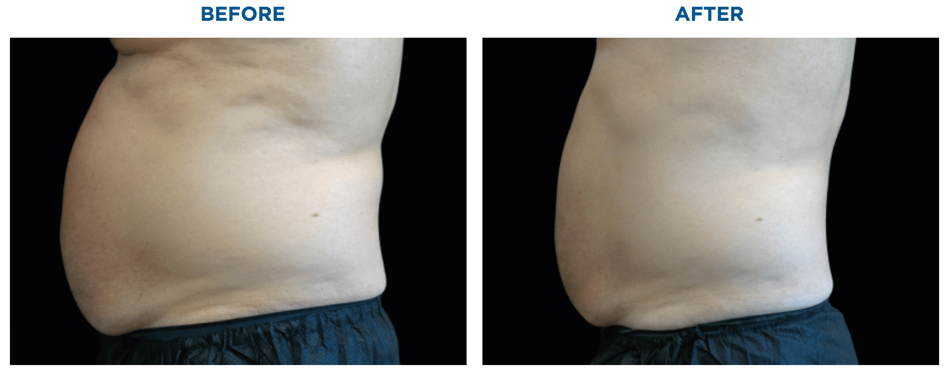 Male abdomen before and after Emsculpt NEO body sculpting.