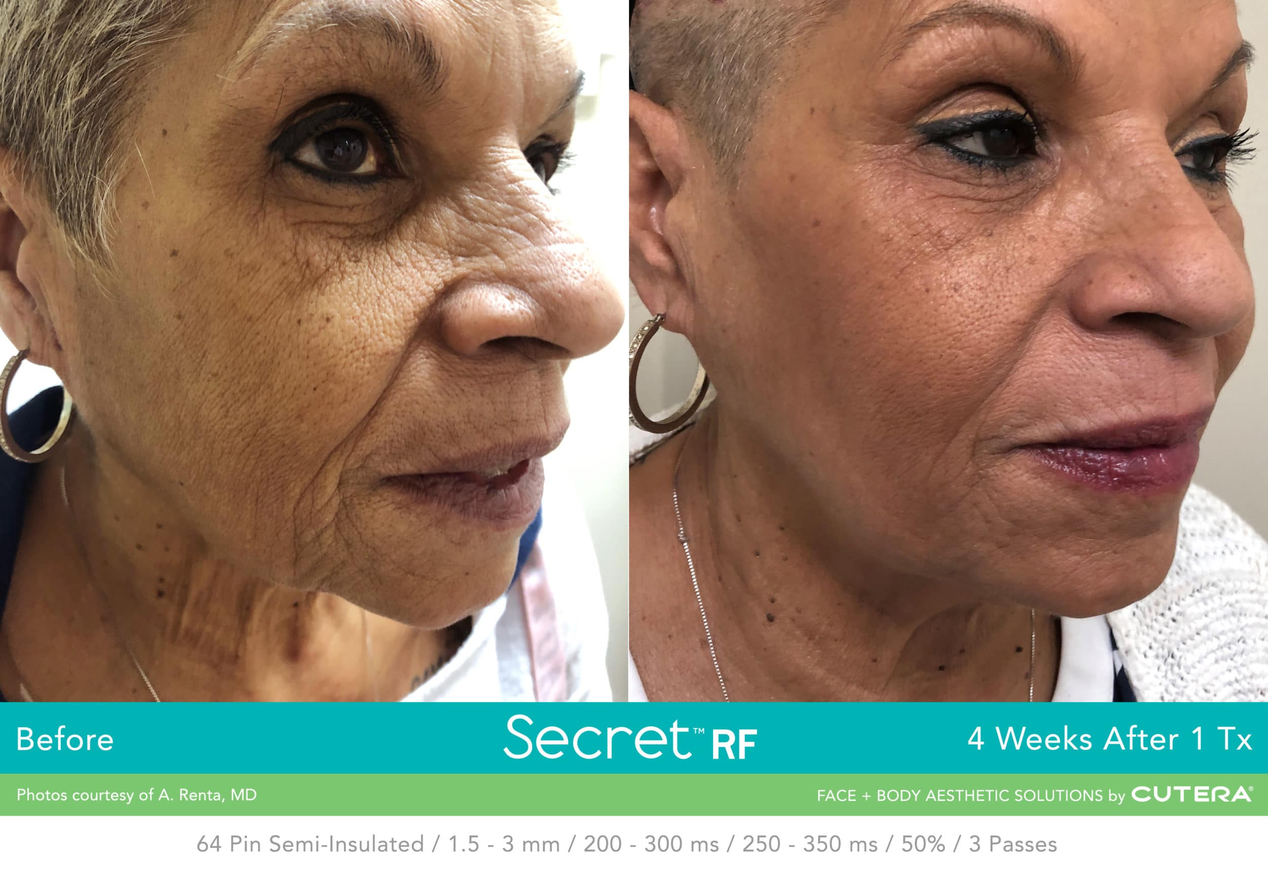 Before & after of woman's face after Secret RF treatment.