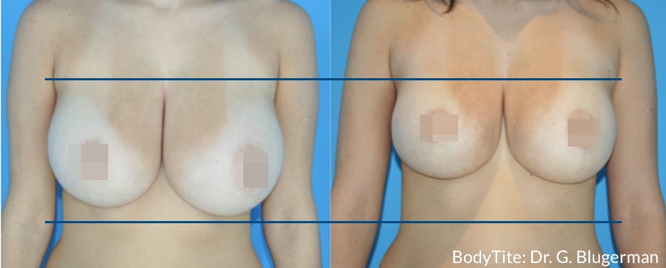 BodyTite GB DS Breast1